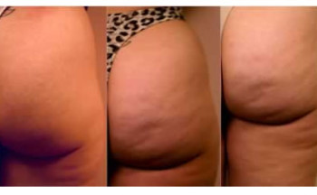 gli stadi della cellulite